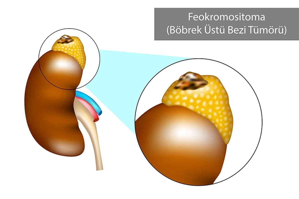 Adrenal Tümörler ve Feokromasitoma